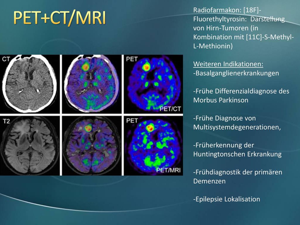 Radiofarmakon: [18F]-Fluorethyltyrosin: Darstellung von Hirn-Tumoren (in Kombination mit [11C]-S-Methyl-L-Methionin)
