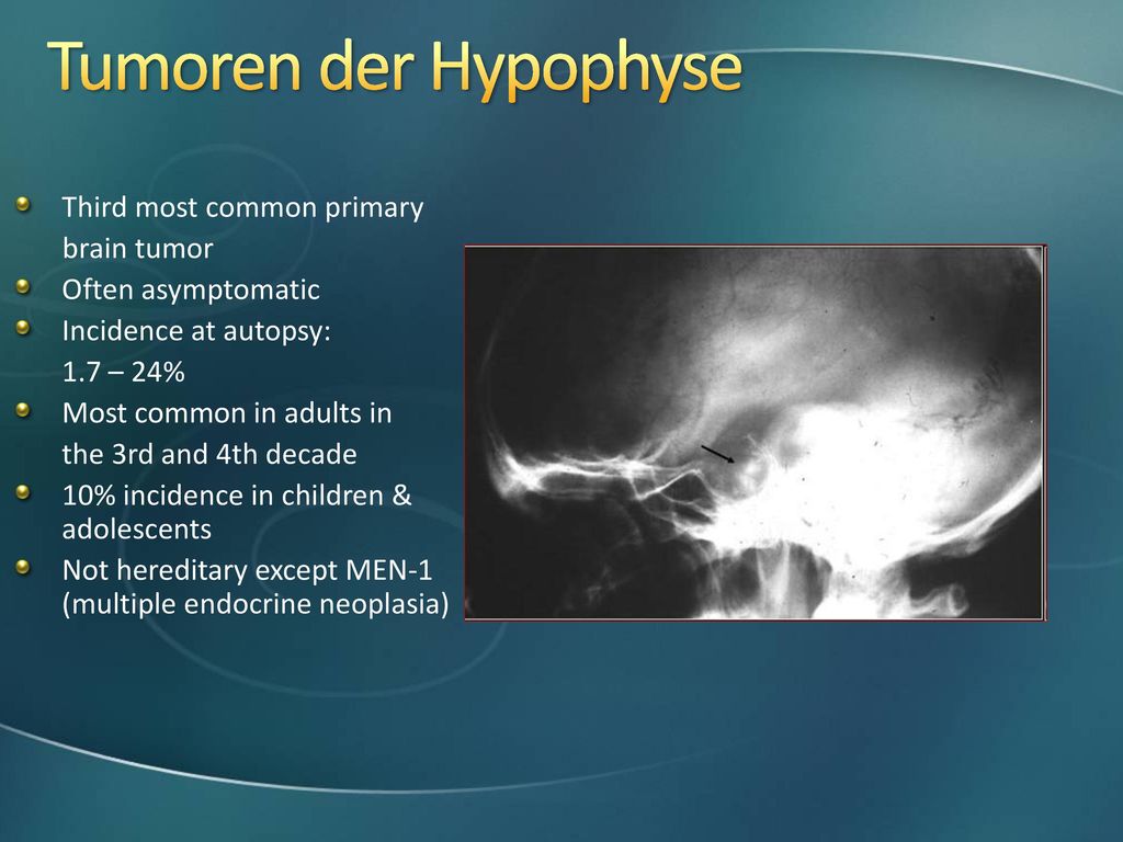 Tumoren der Hypophyse Third most common primary brain tumor