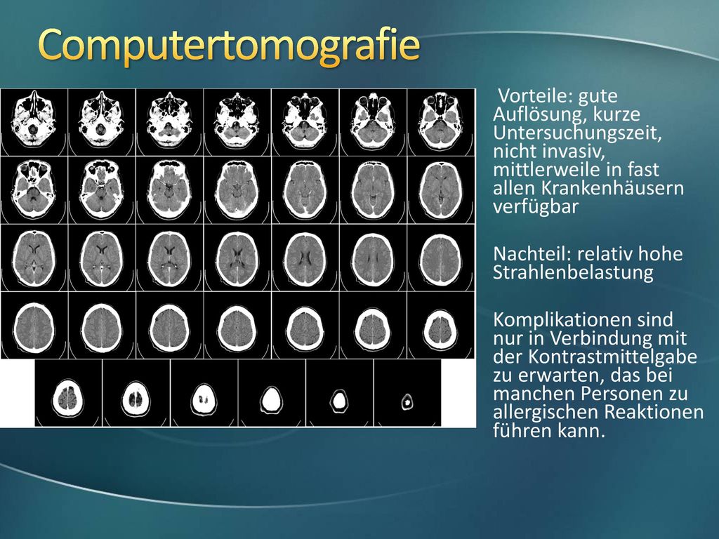 Computertomografie Vorteile: gute Auflösung, kurze Untersuchungszeit, nicht invasiv, mittlerweile in fast allen Krankenhäusern verfügbar.