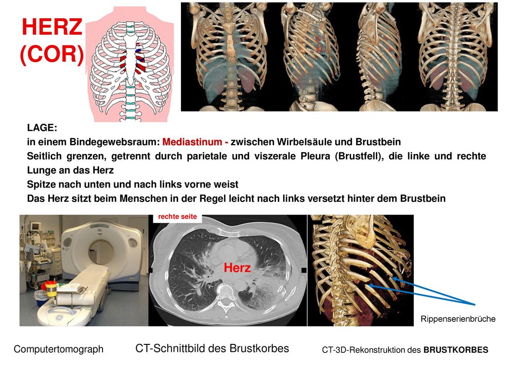 HERZ (COR) Herz CT-Schnittbild des Brustkorbes LAGE: