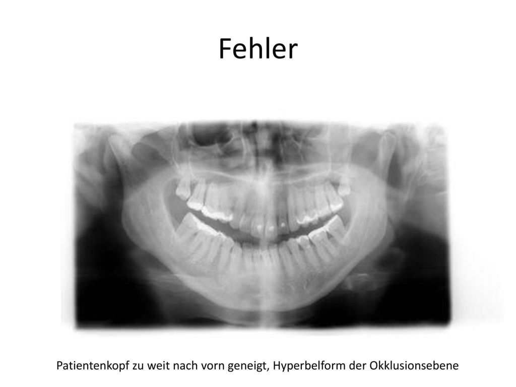 Fehler Patientenkopf zu weit nach vorn geneigt, Hyperbelform der Okklusionsebene