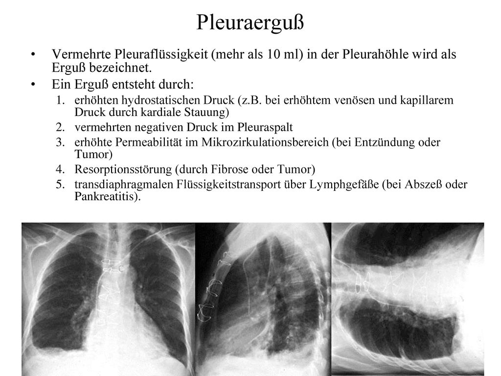 Pleuraerguß Vermehrte Pleuraflüssigkeit (mehr als 10 ml) in der Pleurahöhle wird als Erguß bezeichnet.