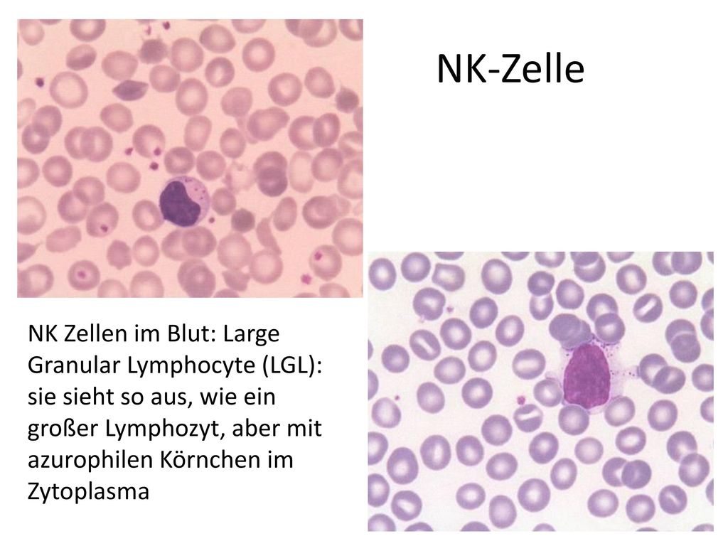 NK-Zelle NK Zellen im Blut: Large Granular Lymphocyte (LGL): sie sieht so aus, wie ein großer Lymphozyt, aber mit azurophilen Körnchen im Zytoplasma.