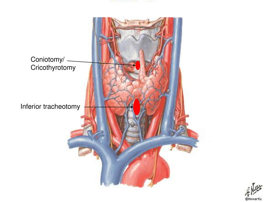 Coniotomy/ Cricothyrotomy. Inferior tracheotomy. coniotomy. (cricothyrotomy) tracheotomy. coniotomy.