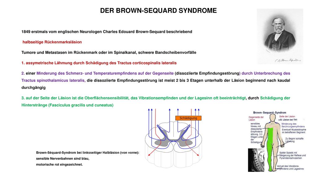 DER BROWN-SEQUARD SYNDROME