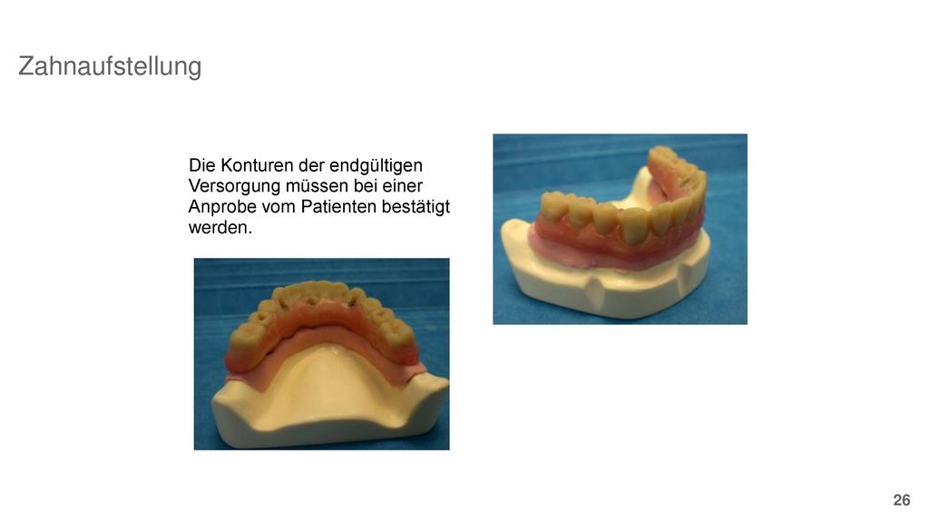 Zahnaufstellung Die Konturen der endgültigen Versorgung müssen bei einer Anprobe vom Patienten bestätigt werden.