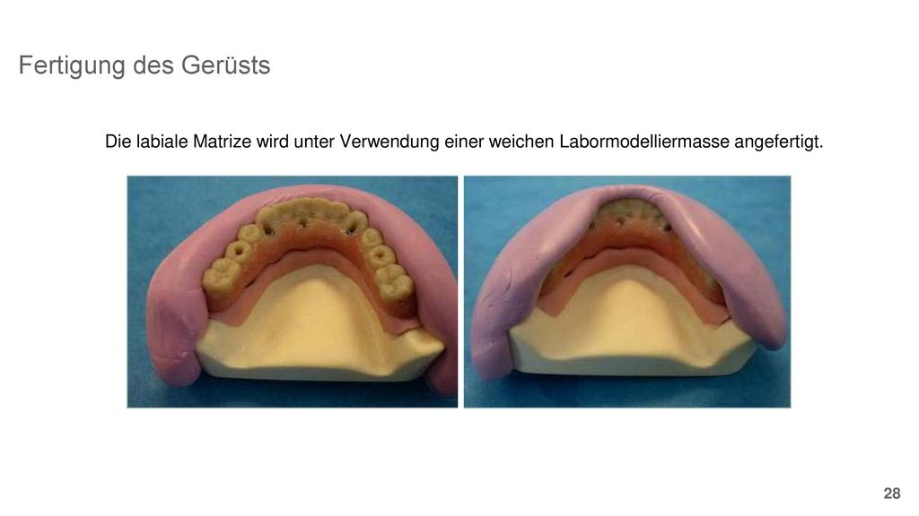 Fertigung des Gerüsts Die labiale Matrize wird unter Verwendung einer weichen Labormodelliermasse angefertigt.