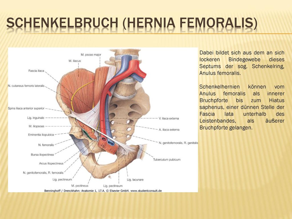 Schenkelbruch (Hernia Femoralis)