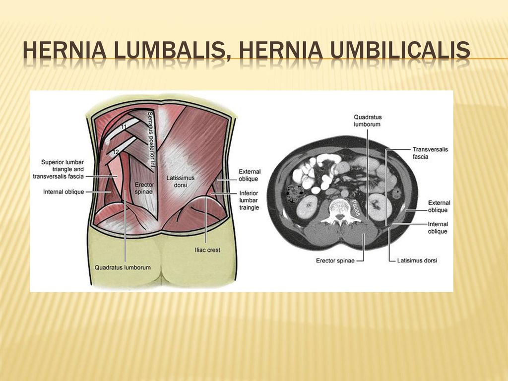 Hernia Lumbalis, Hernia umbilicalis
