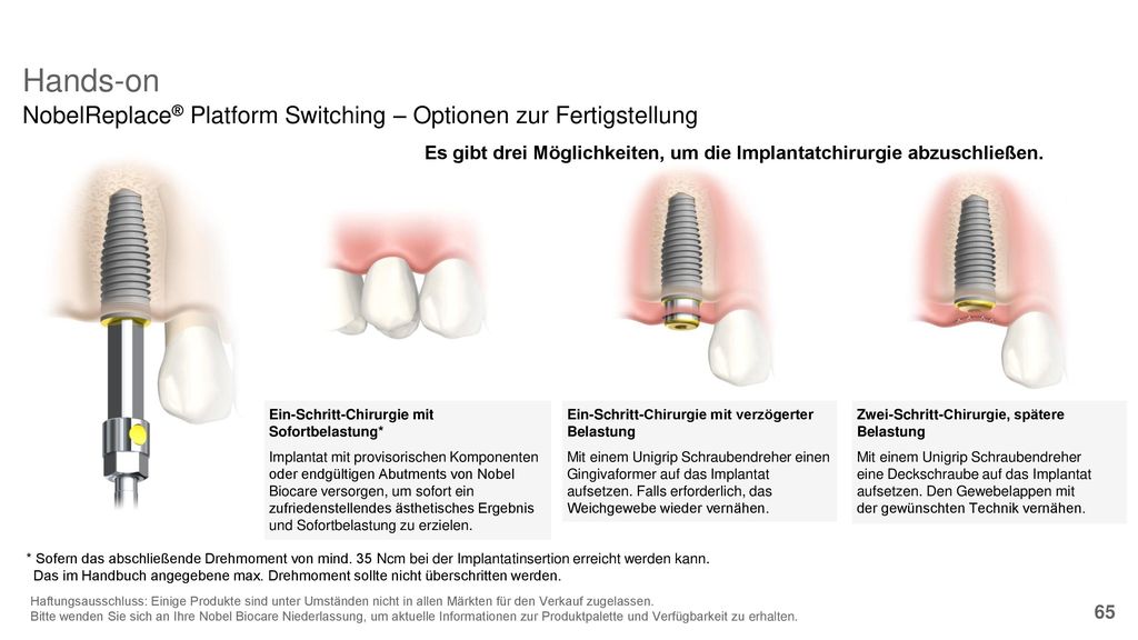 Hands-on NobelReplace® Platform Switching – Optionen zur Fertigstellung. Es gibt drei Möglichkeiten, um die Implantatchirurgie abzuschließen.