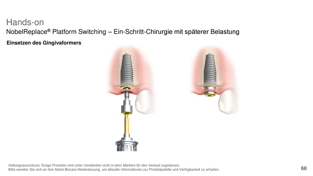 8/29/2018 Hands-on. NobelReplace® Platform Switching – Ein-Schritt-Chirurgie mit späterer Belastung.
