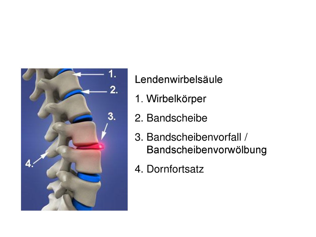 Lendenwirbelsäule 1. Wirbelkörper. 2. Bandscheibe. 3. Bandscheibenvorfall / Bandscheibenvorwölbung.