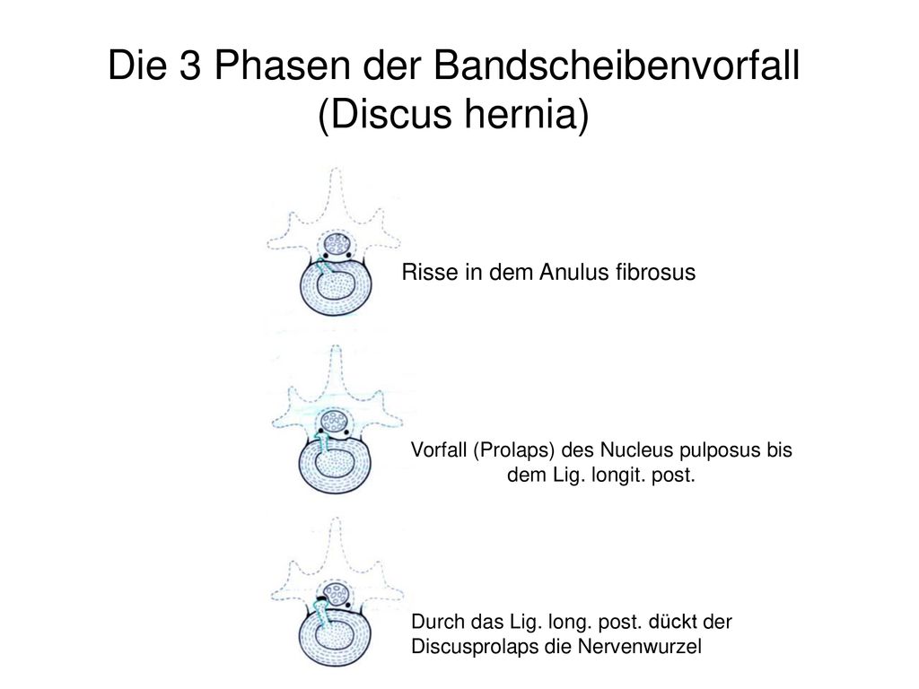 Die 3 Phasen der Bandscheibenvorfall (Discus hernia)