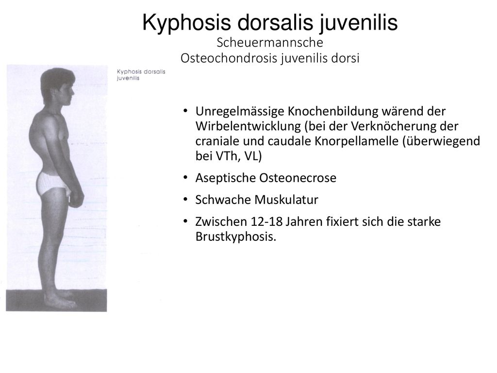 Kyphosis dorsalis juvenilis Scheuermannsche Osteochondrosis juvenilis dorsi