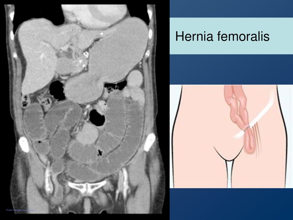 Hernia femoralis From: Google search.com