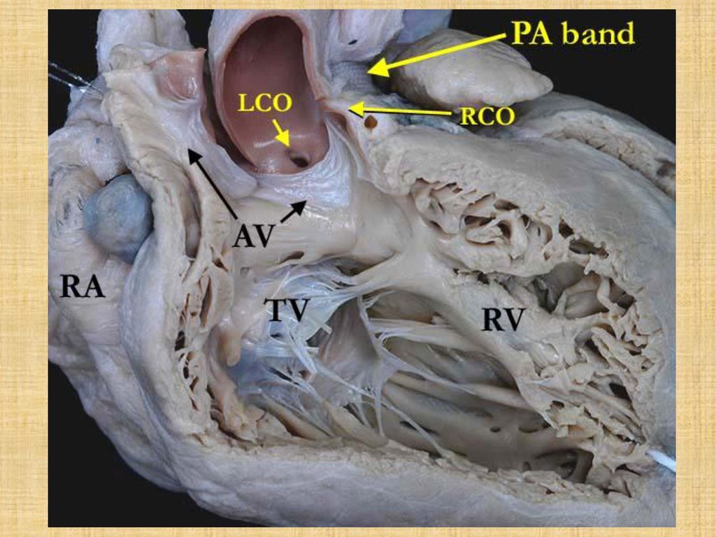 A close up view of the heart shown in the left panel with the anterior portion of the aortic valve (AV) opened to demonstrate the discordant atrioventricular connections consistent with transposition of the great arteries. The aorta is anterior to the pulmonary trunk with a pulmonary artery (PA) band in place. The right coronary orifice (RCO) is adjacent to a commissure. Note the muscular infundibulum separating the aortic valve from the tricuspid valve (TV). (RA-right atrium)