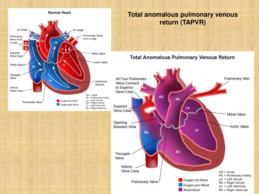 Total anomalous pulmonary venous return (TAPVR)