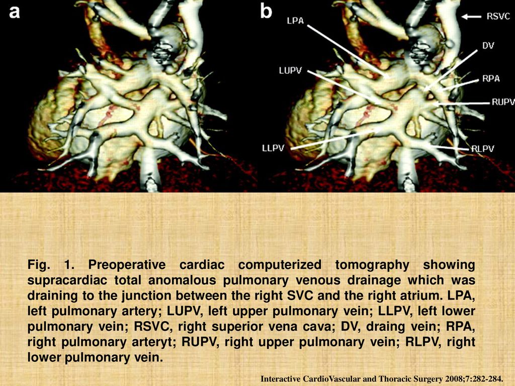 Fig. 1. Preoperative cardiac computerized tomography showing supracardiac total anomalous pulmonary venous drainage which was draining to the junction between the right SVC and the right atrium. LPA, left pulmonary artery; LUPV, left upper pulmonary vein; LLPV, left lower pulmonary vein; RSVC, right superior vena cava; DV, draing vein; RPA, right pulmonary arteryt; RUPV, right upper pulmonary vein; RLPV, right lower pulmonary vein.