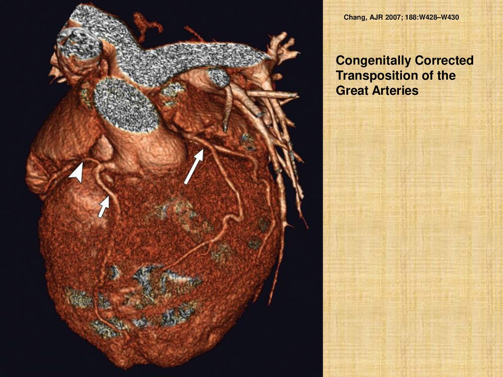 Congenitally Corrected Transposition of the Great Arteries