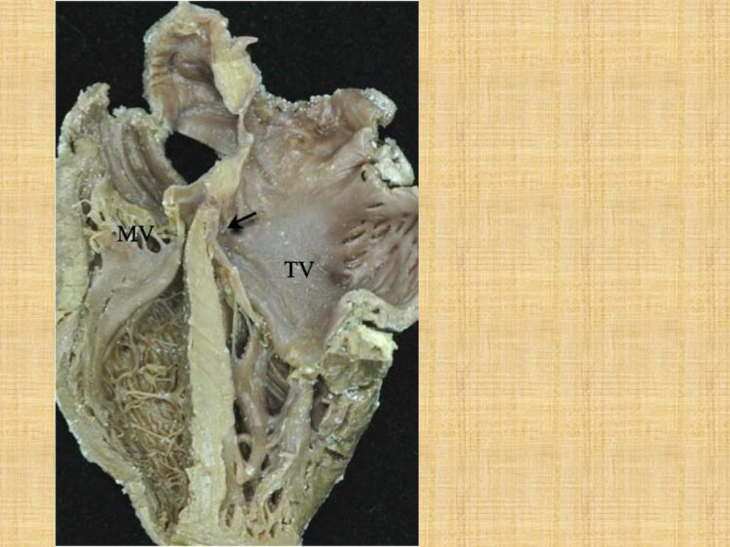 Note the reversed off-setting of the attachments of the leaflets of the atrioventricular valves to the septum (Arrow), with the mitral valve (MV) on the right side attached appreciably higher that the tricuspid valve (TV) on the left side.