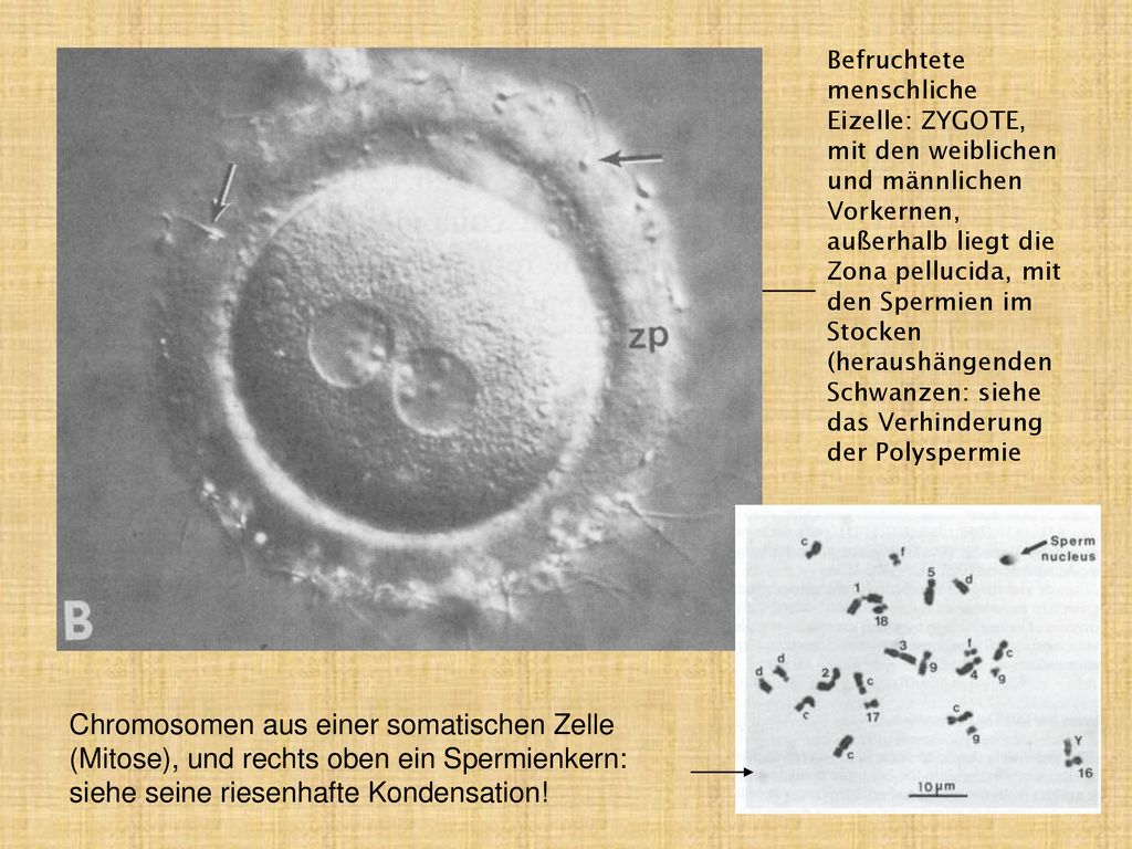 Befruchtete menschliche Eizelle: ZYGOTE, mit den weiblichen und männlichen Vorkernen, außerhalb liegt die Zona pellucida, mit den Spermien im Stocken (heraushängenden Schwanzen: siehe das Verhinderung der Polyspermie