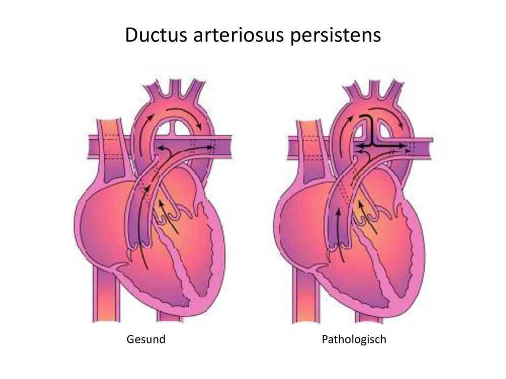 Ductus arteriosus persistens