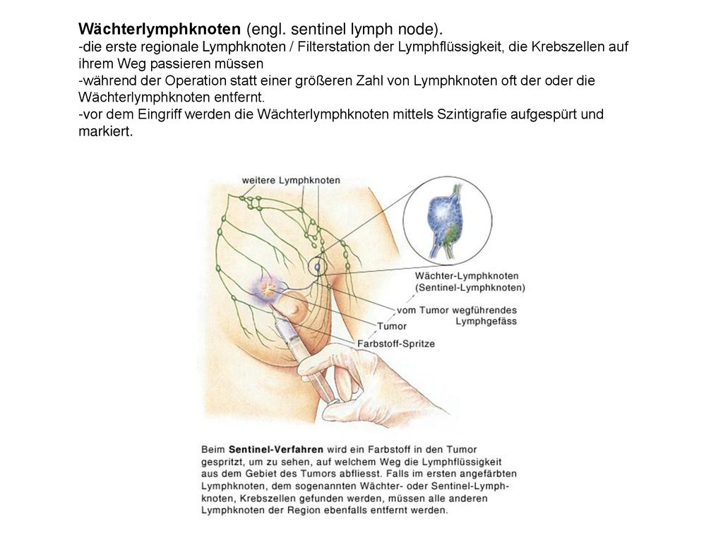 Wächterlymphknoten (engl. sentinel lymph node).