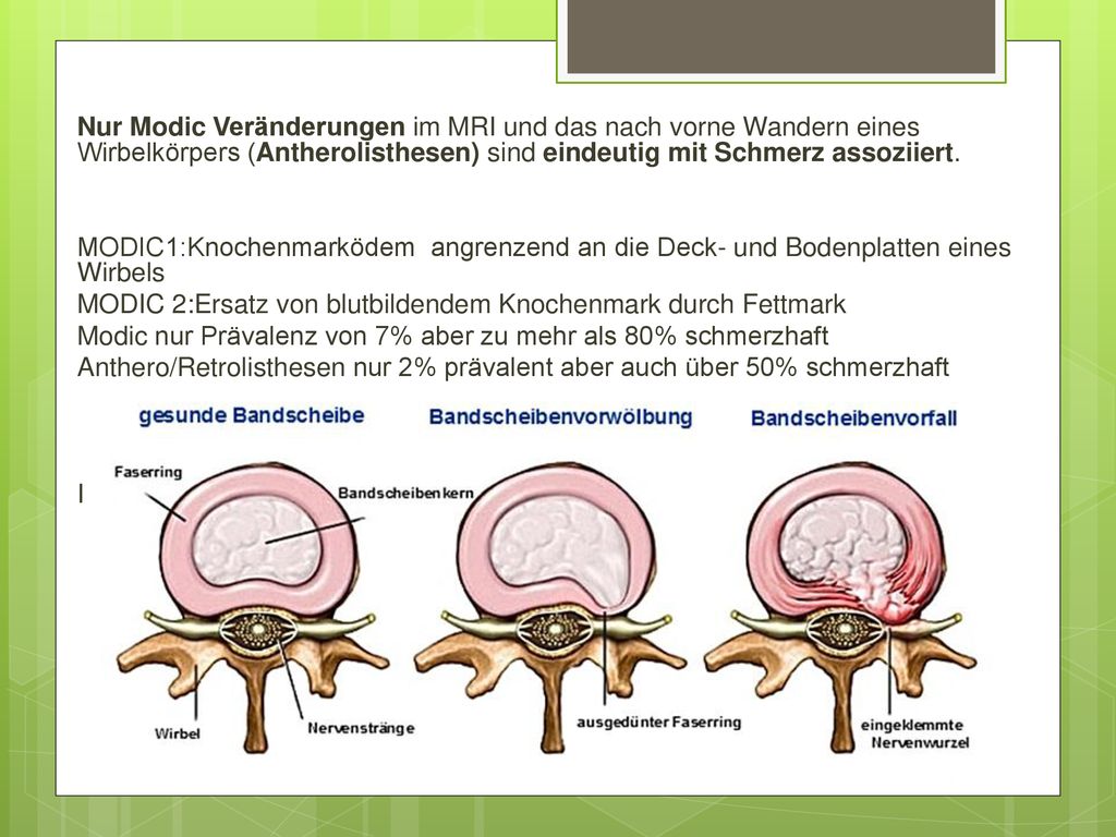 Nur Modic Veränderungen im MRI und das nach vorne Wandern eines Wirbelkörpers (Antherolisthesen) sind eindeutig mit Schmerz assoziiert.