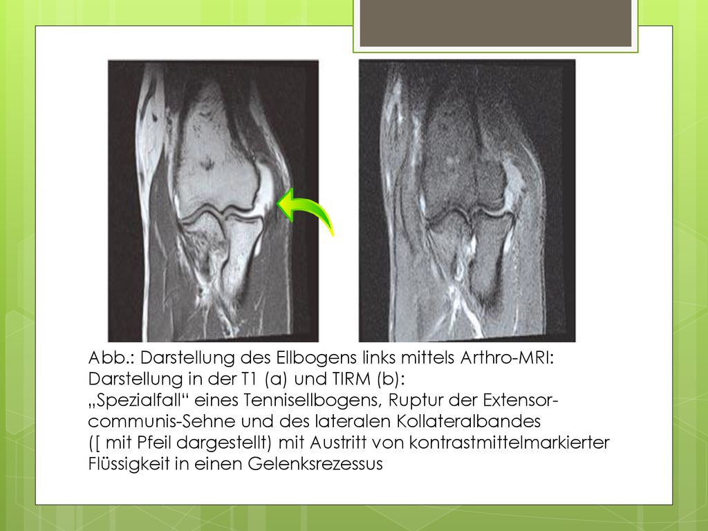 Abb.: Darstellung des Ellbogens links mittels Arthro-MRI: Darstellung in der T1 (a) und TIRM (b):