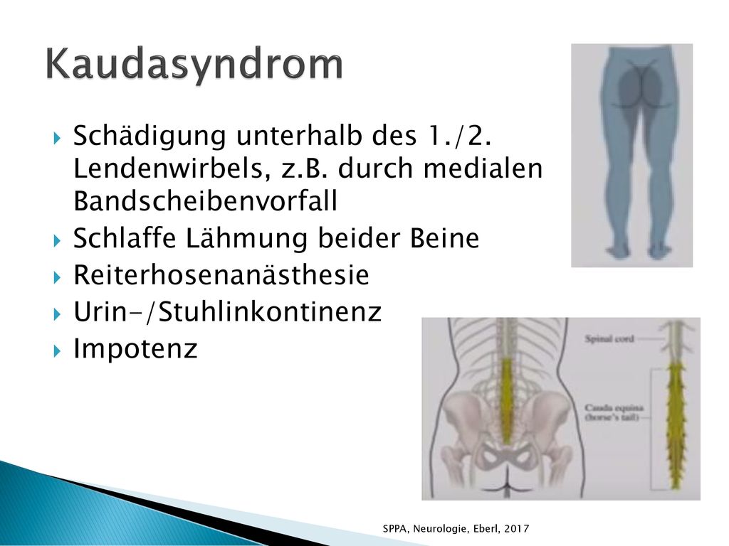 Kaudasyndrom Schädigung unterhalb des 1./2. Lendenwirbels, z.B. durch medialen Bandscheibenvorfall.