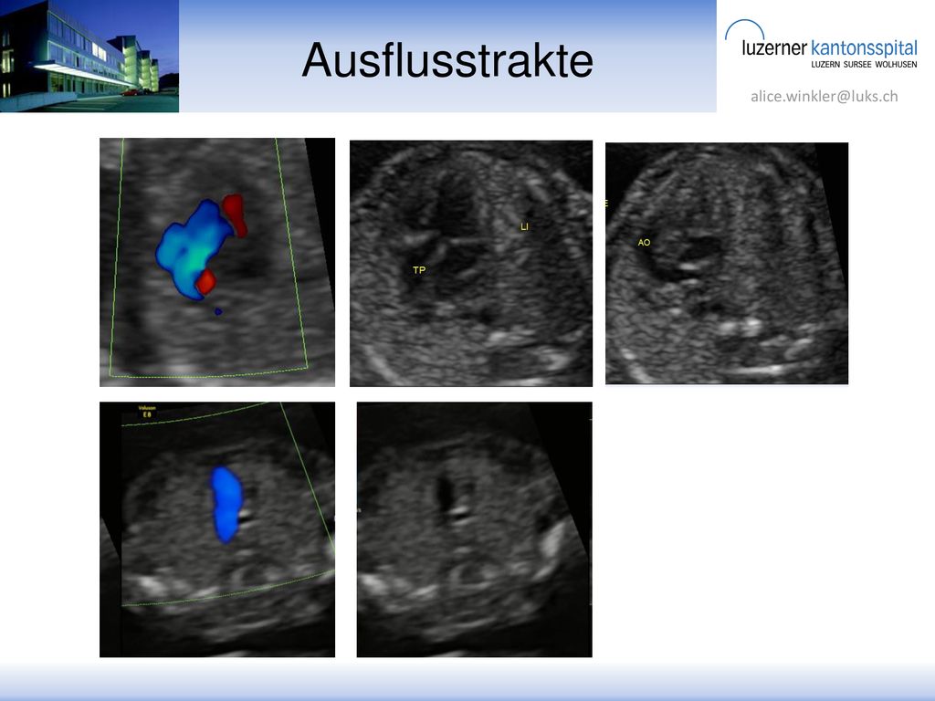 Ausflusstrakte Paralleler Abgang, Farbdoppler hilft bei der Identifikation des Abgangs der Gefässe