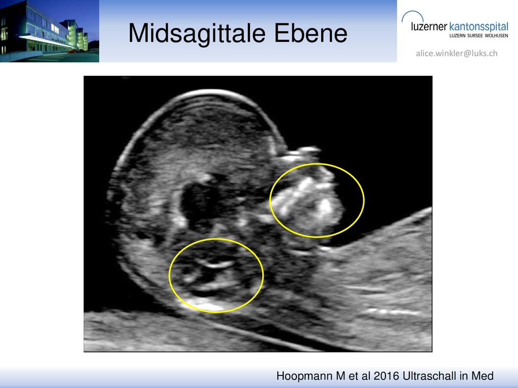 Midsagittale Ebene Hoopmann M et al 2016 Ultraschall in Med