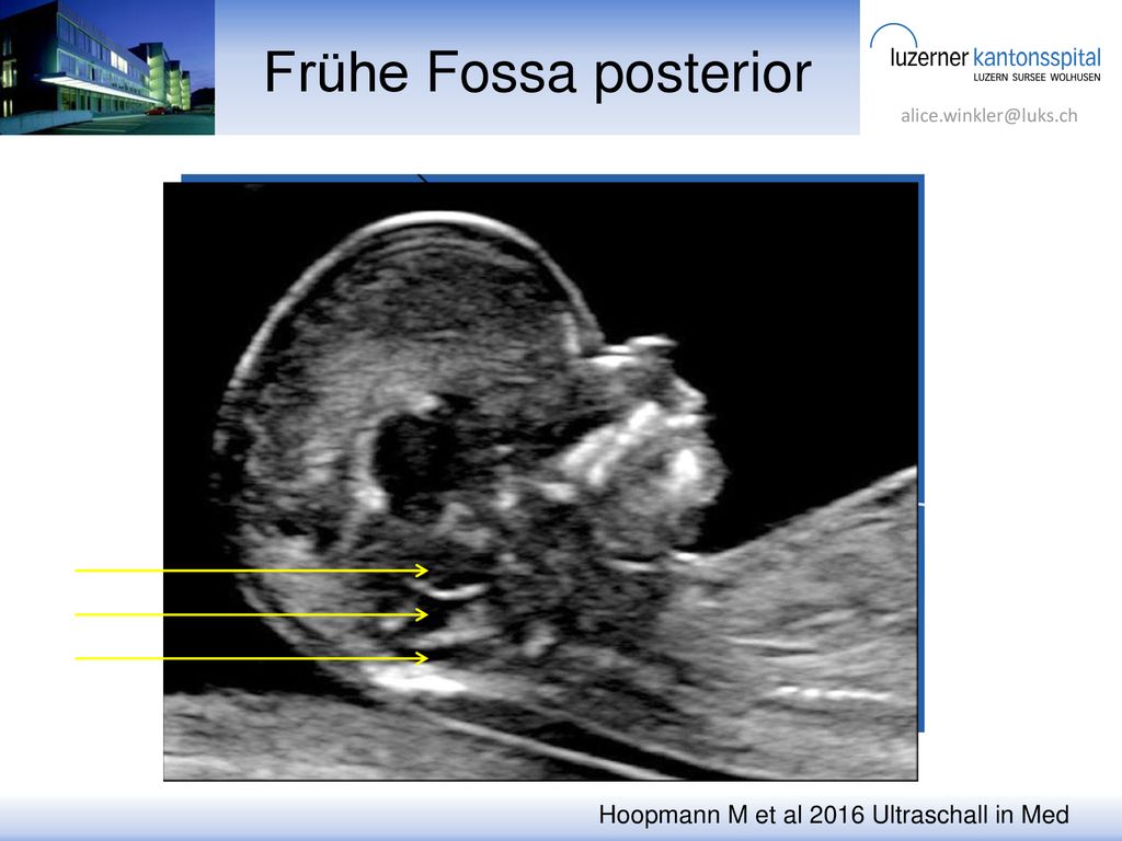 Frühe Fossa posterior Hoopmann M et al 2016 Ultraschall in Med