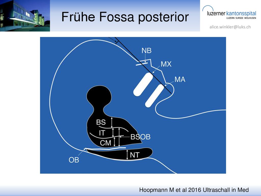 Frühe Fossa posterior Hoopmann M et al 2016 Ultraschall in Med
