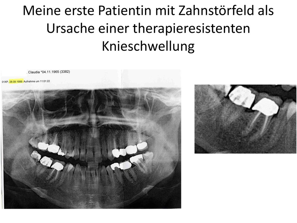 Meine erste Patientin mit Zahnstörfeld als Ursache einer therapieresistenten Knieschwellung