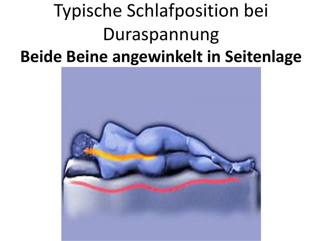 Typische Schlafposition bei Duraspannung Beide Beine angewinkelt in Seitenlage