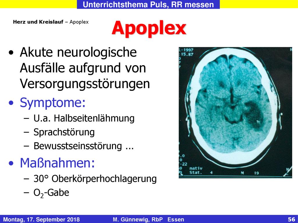 Apoplex Akute neurologische Ausfälle aufgrund von Versorgungsstörungen