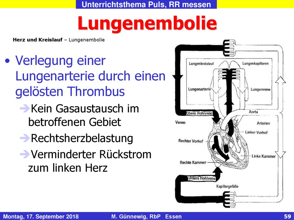 Lungenembolie Herz und Kreislauf – Lungenembolie. Verlegung einer Lungenarterie durch einen gelösten Thrombus.