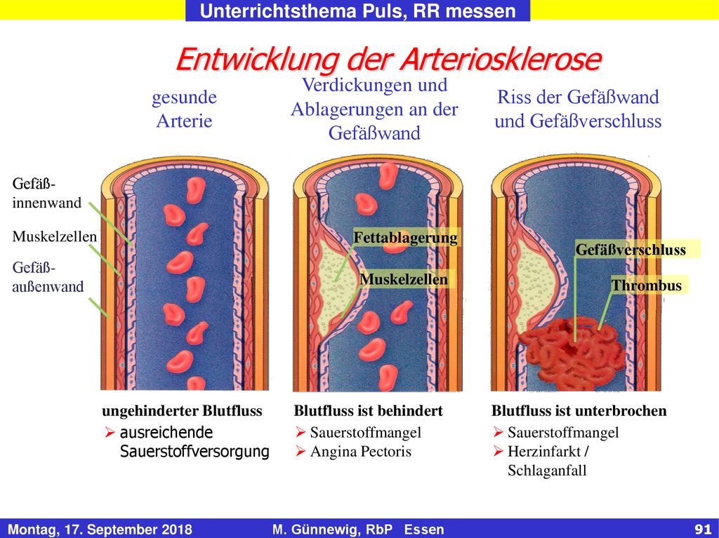 Entwicklung der Arteriosklerose