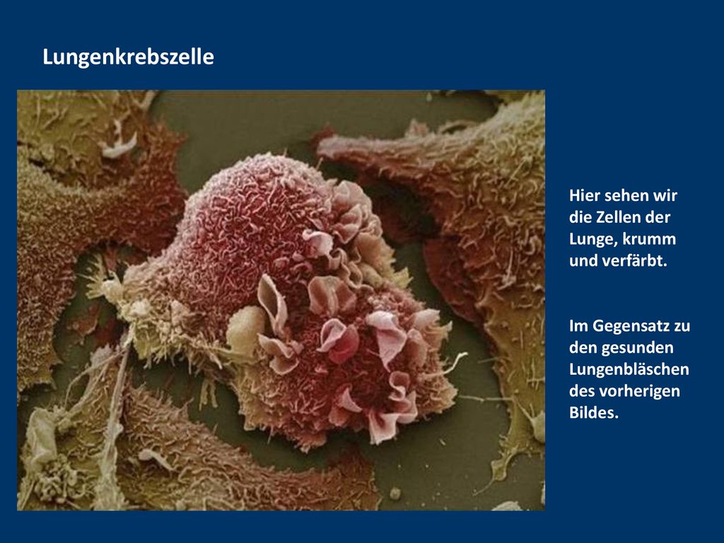 Lungenkrebszelle Hier sehen wir die Zellen der Lunge, krumm und verfärbt.
