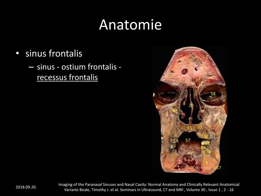 Anatomie sinus frontalis sinus - ostium frontalis - recessus frontalis