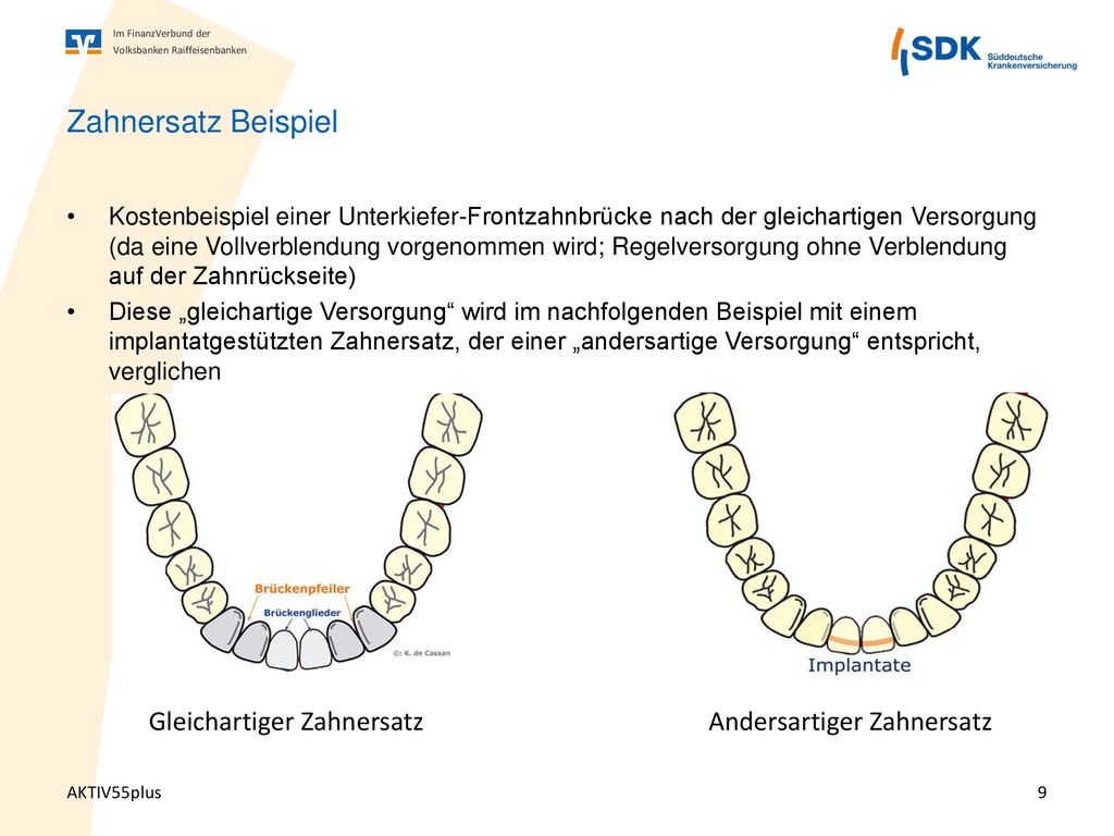 Zahnersatz Beispiel Gleichartiger Zahnersatz Andersartiger Zahnersatz