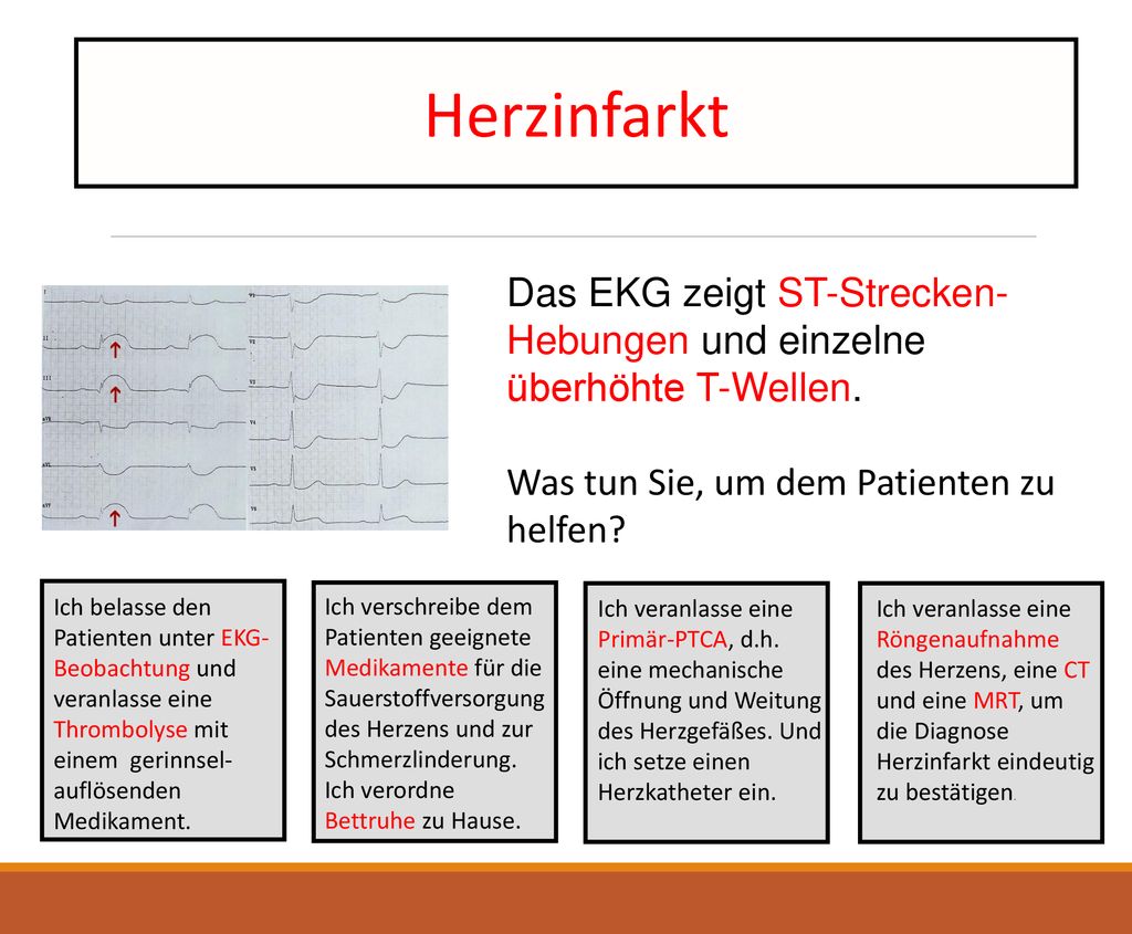 Herzinfarkt Das EKG zeigt ST-Strecken-Hebungen und einzelne überhöhte T-Wellen. Was tun Sie, um dem Patienten zu helfen