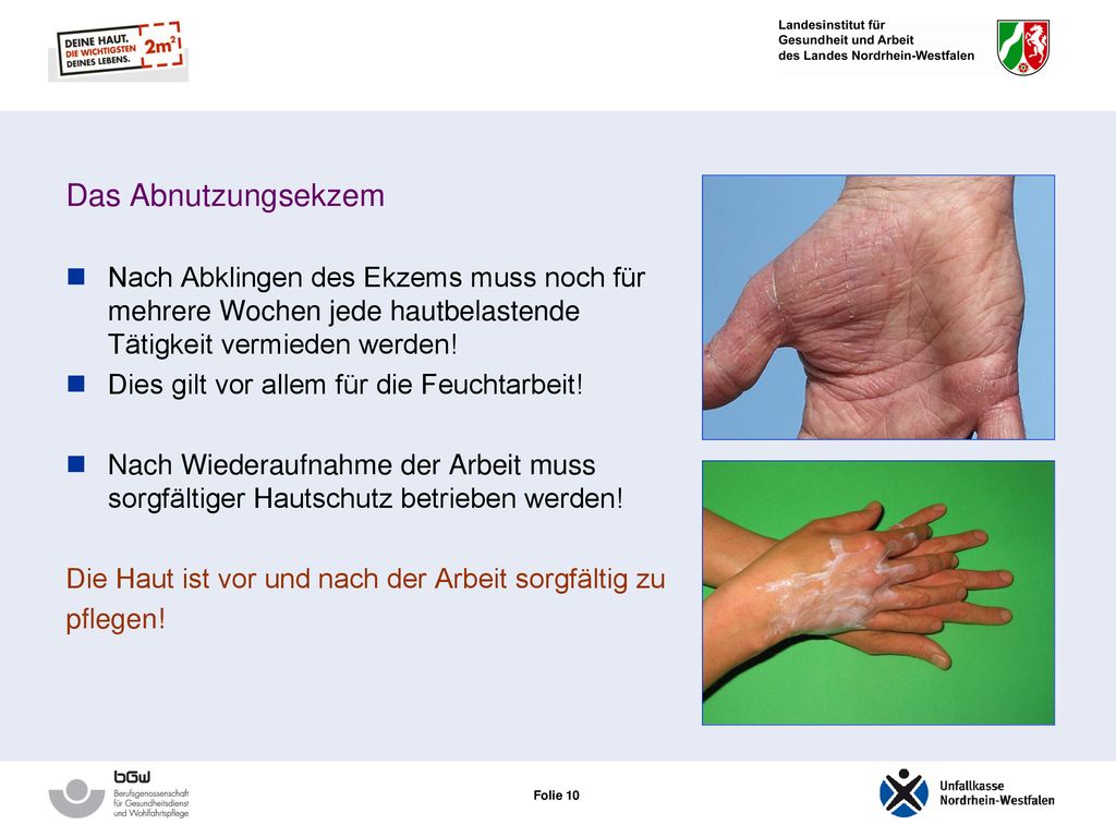 Das Abnutzungsekzem Nach Abklingen des Ekzems muss noch für mehrere Wochen jede hautbelastende Tätigkeit vermieden werden!