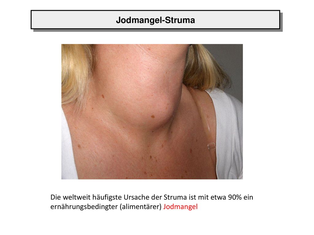 Jodmangel-Struma Die weltweit häufigste Ursache der Struma ist mit etwa 90% ein ernährungsbedingter (alimentärer) Jodmangel.