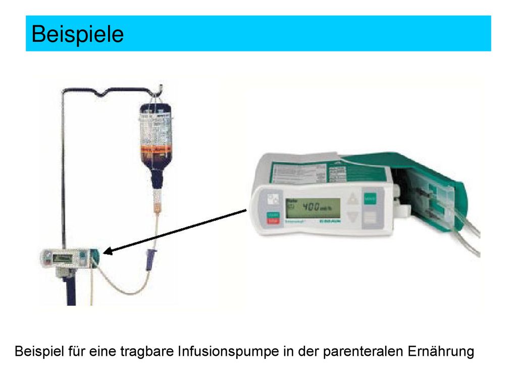 Beispiele Beispiel für eine tragbare Infusionspumpe in der parenteralen Ernährung