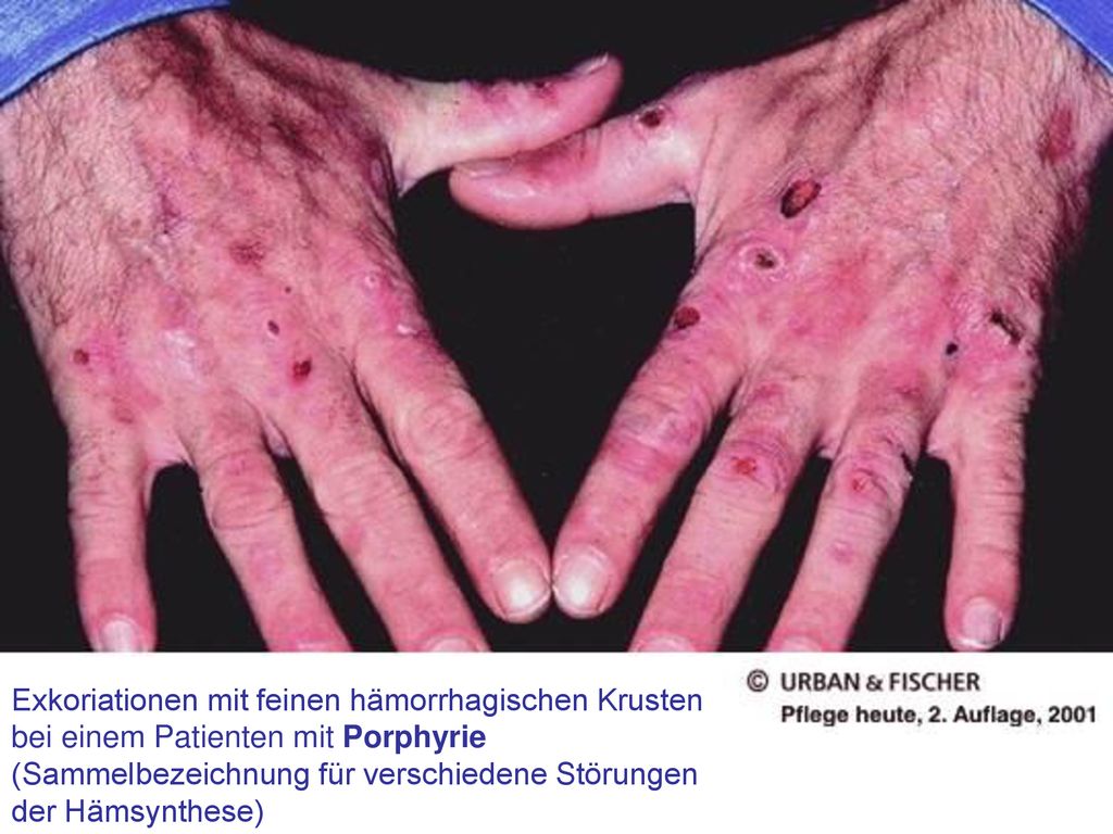 Exkoriationen mit feinen hämorrhagischen Krusten bei einem Patienten mit Porphyrie (Sammelbezeichnung für verschiedene Störungen der Hämsynthese)