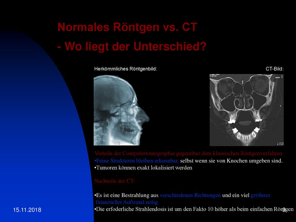 Normales Röntgen vs. CT - Wo liegt der Unterschied