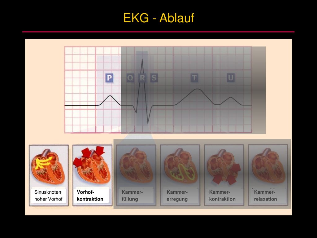 EKG - Ablauf Sinusknoten hoher Vorhof Vorhof- kontraktion Kammer-