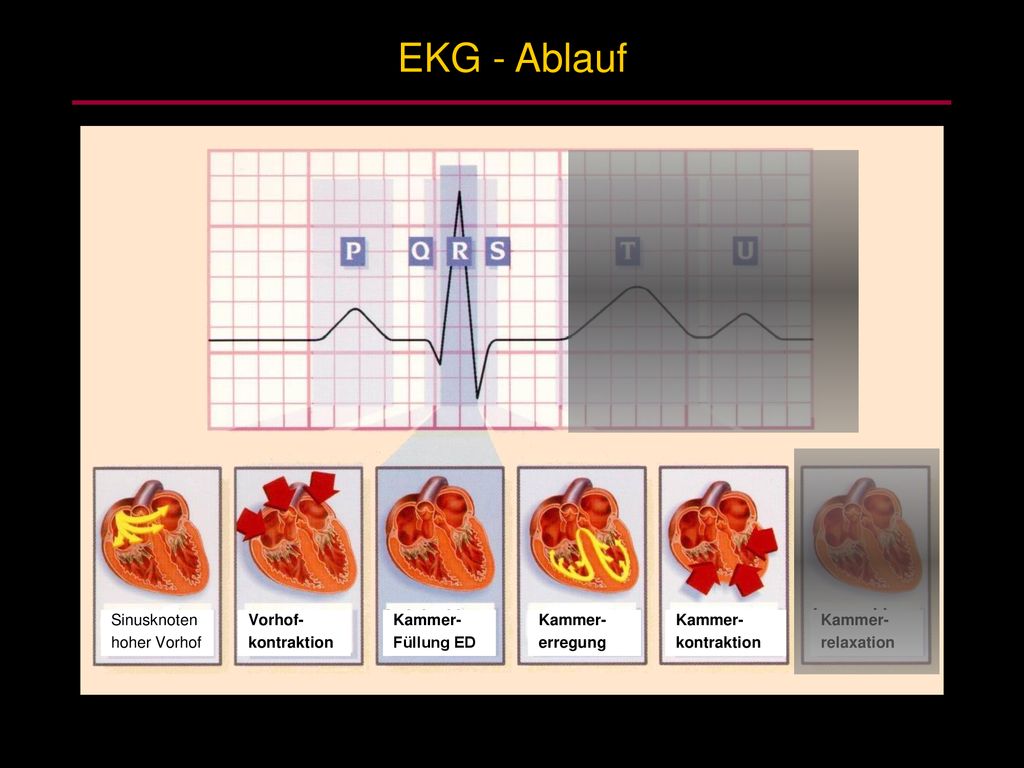 EKG - Ablauf Sinusknoten hoher Vorhof Vorhof- kontraktion Kammer-